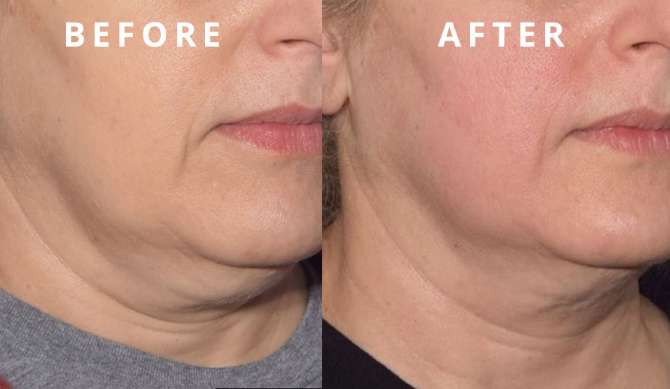 Emsella Before and After Photos